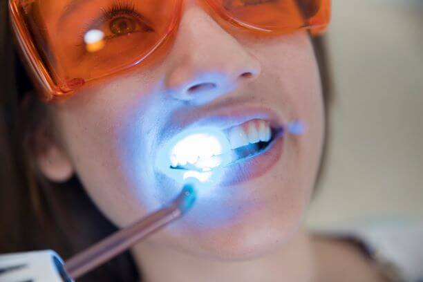 laser assisted teeth whitening