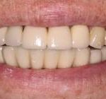 teeth one day implants after